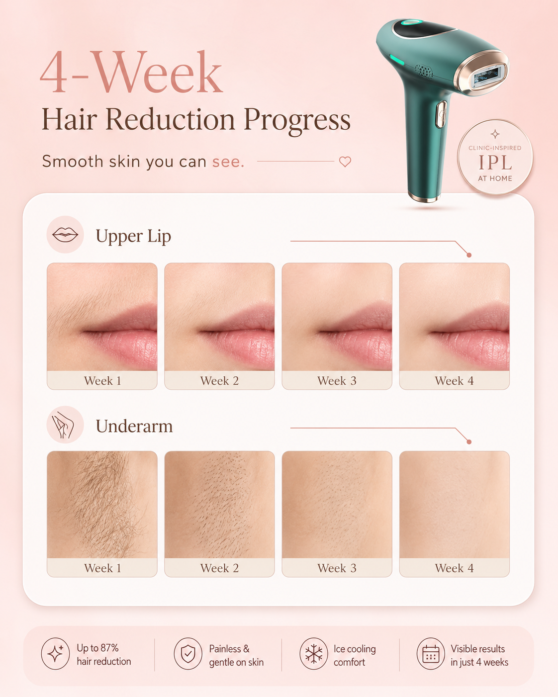 Illustration of gradual IPL hair removal progress with regular use